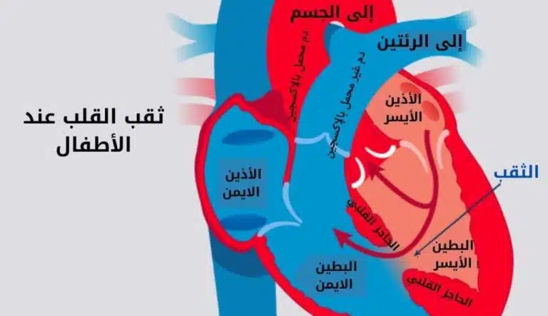 ثقب بين البطينين