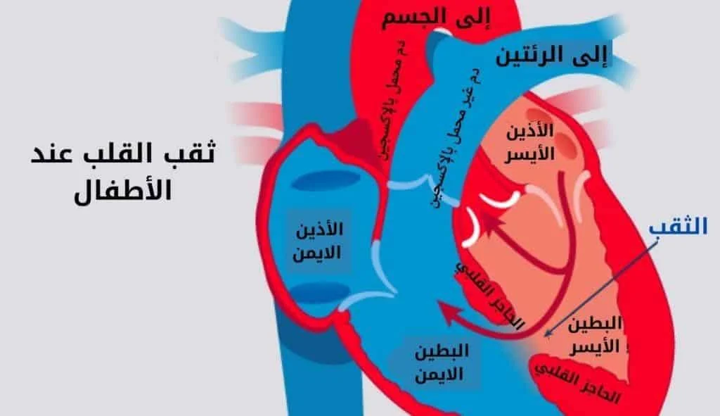 الصفحة الرئيسية 6 ثقب بين البطينين