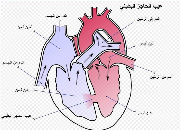ثقب بين البطينين