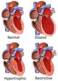 اعتلال عضلة القلب التقييدي (RCM): تضخم القلب في الاطفال