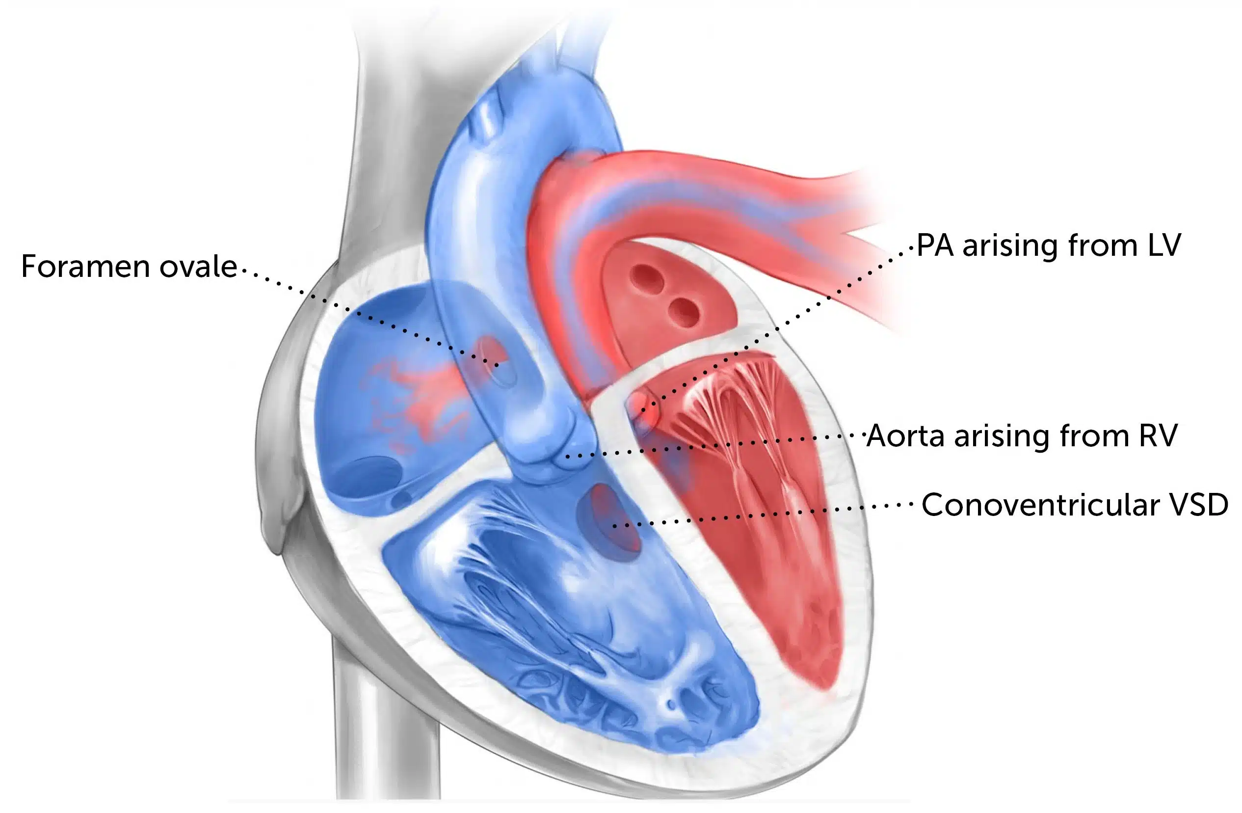 الصفحة الرئيسية 9 تبادل منشأ الشرايين الكبيرة عند الاطفال