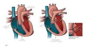 تحويل الشرايين الكبيرة
