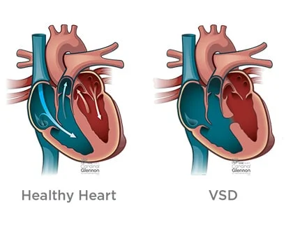 ثقب القلب بين البطينين عند الاطفال