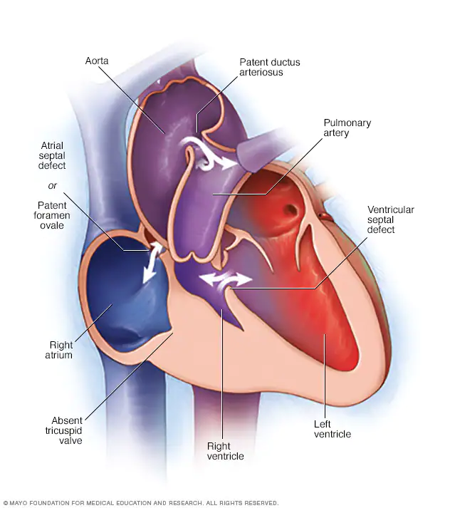 رتق الصمام ثلاثي الشرف Tricuspid Atresia 1 رتق الصمام ثلاثي الشرف