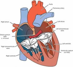عيب القناة الاذينية البطينية