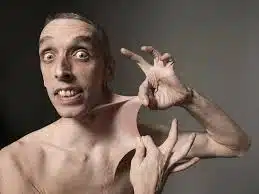 متلازمة مارفان 7 متلازمة مارفان