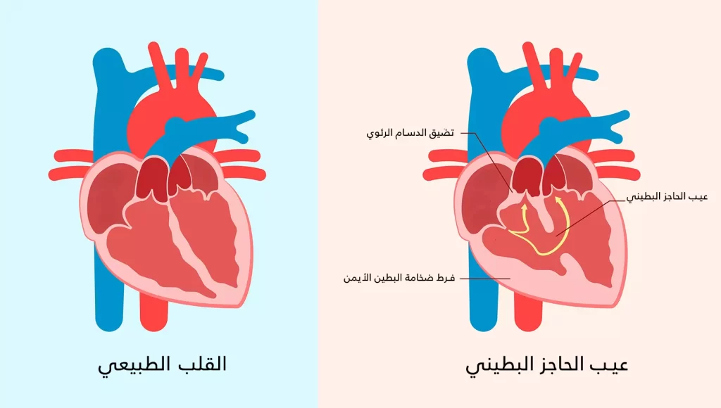 مشاكل القلب الخلقية ومتلازمة داون ثقب بين البطينين