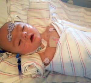 مضاعفات عملية القلب المفتوح عند الرضع