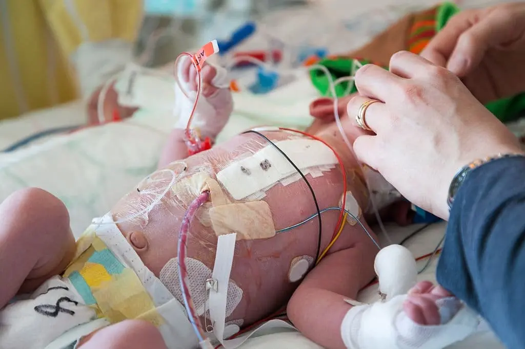 مضاعفات عملية القلب المفتوح عند الرضع