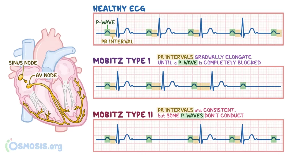احصار القلب عند الاطفال Heart block 5 احصار القلب عند الاطفال