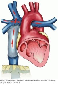 عملية فونتان مركبة