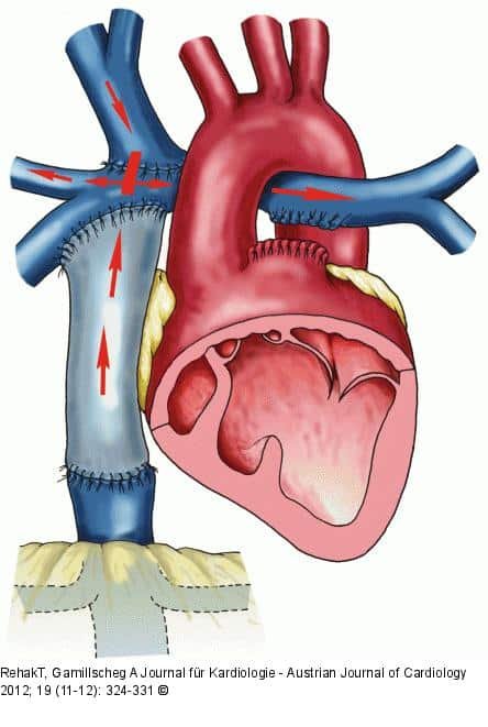 عملية فونتان مركبة 3 عملية فونتان مركبة