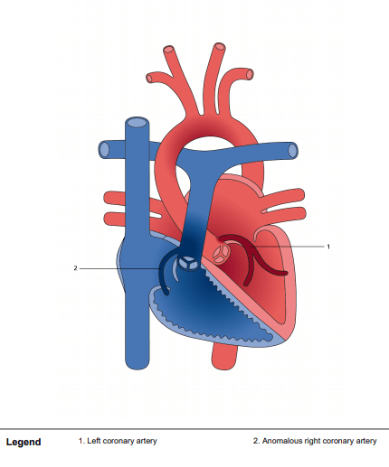 العيوب الخلقية في الشرايين التاجية