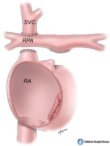 إجراء غلين - عملية جلين