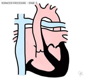 إجراء نوروود 2 إجراء نوروود او عملية نوروود