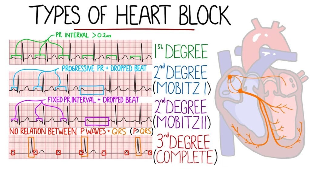 احصار القلب عند الاطفال Heart block 4 احصار القلب عند الاطفال