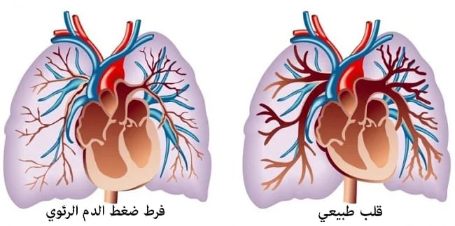 ارتفاع ضغط الشريان الرئوي عند الأطفال 3 ارتفاع ضغط الشريان الرئوي عند الأطفال