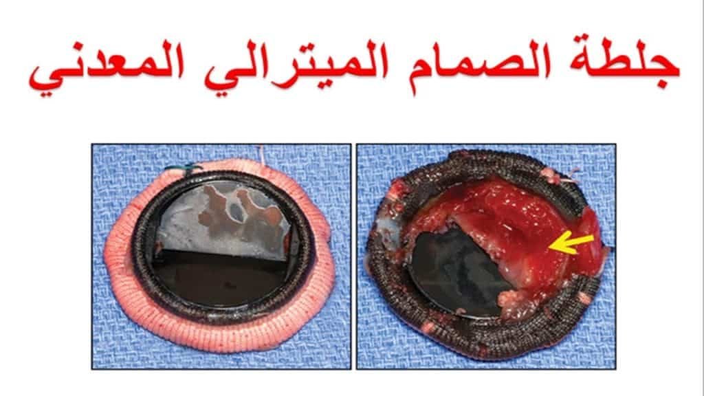 صمام القلب المعدني 2 جلطه صمام القلب المعدني