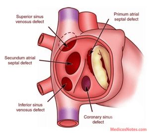 الثقب بين الاذينين