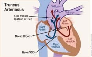 الجذع الشرياني المستمر