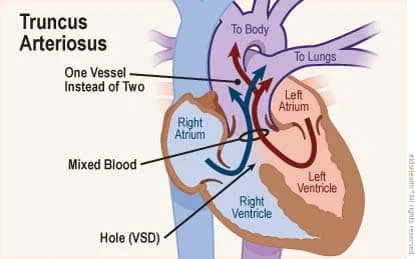 الصفحة الرئيسية 9 الجذع الشرياني المستمر
