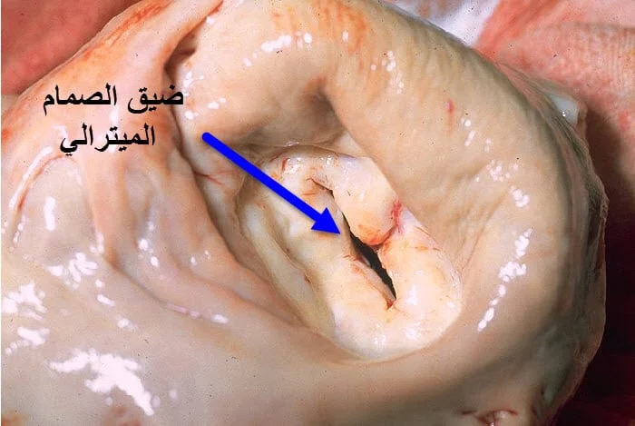 امراض الصمام الميترالي 4 امراض الصمام الميترالي