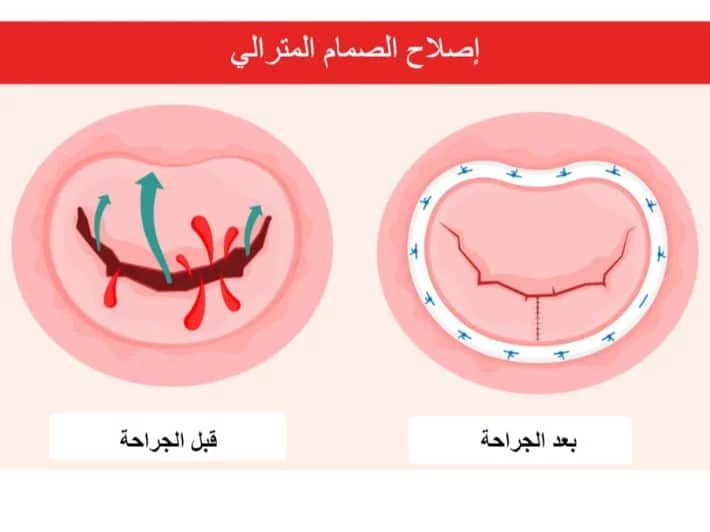 امراض الصمام الميترالي 2 امراض الصمام الميترالي