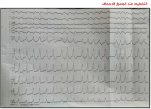 متلازمة وولف باركنسون وايت