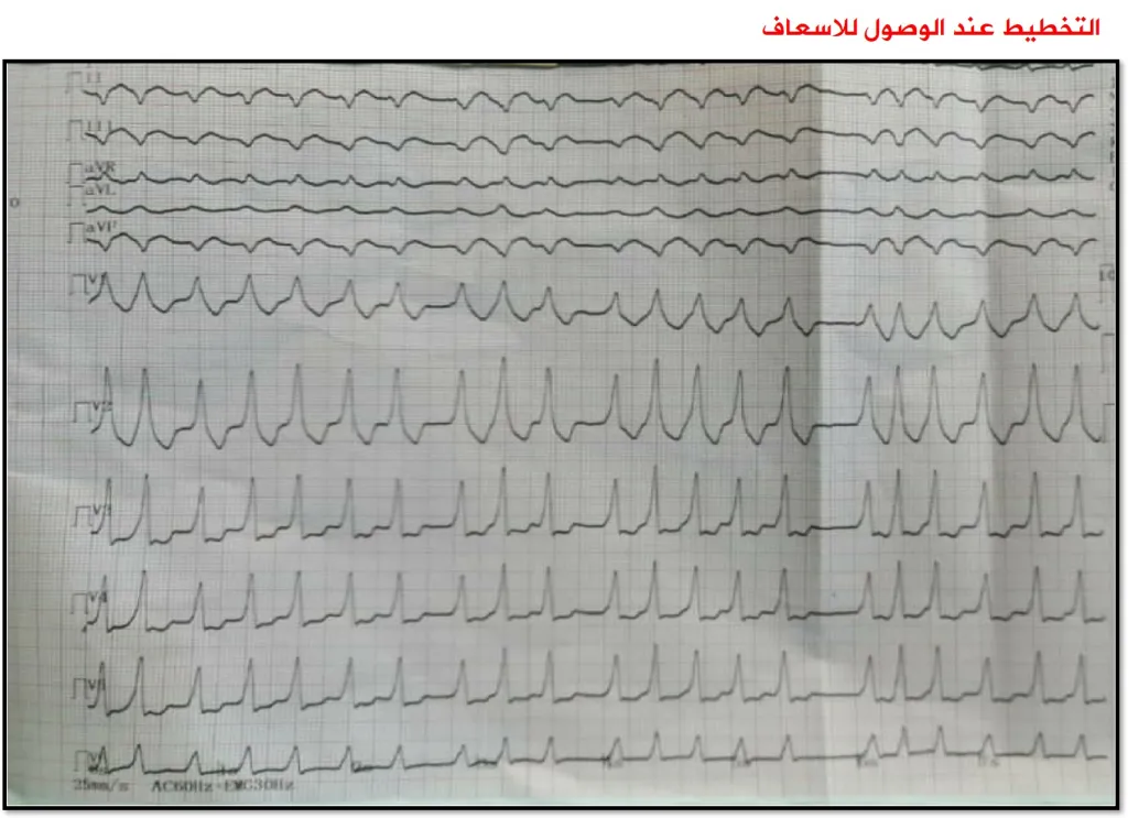 متلازمة وولف باركنسون وايت