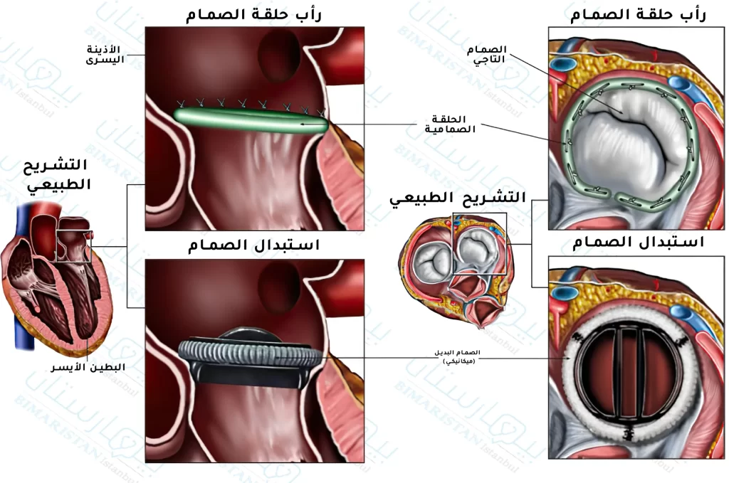 تغيير صمامات القلب التالفة في الاطفال 3 تغيير صمامات القلب في الاطفال
