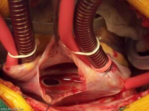 ثقب القلب عند البالغين