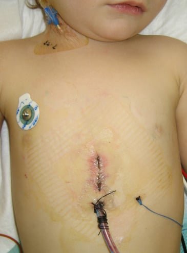 جراحة قلب الاطفال قليلة التوغل