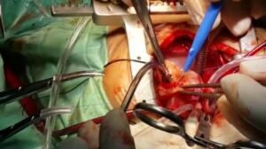 خطورة القلب المفتوح