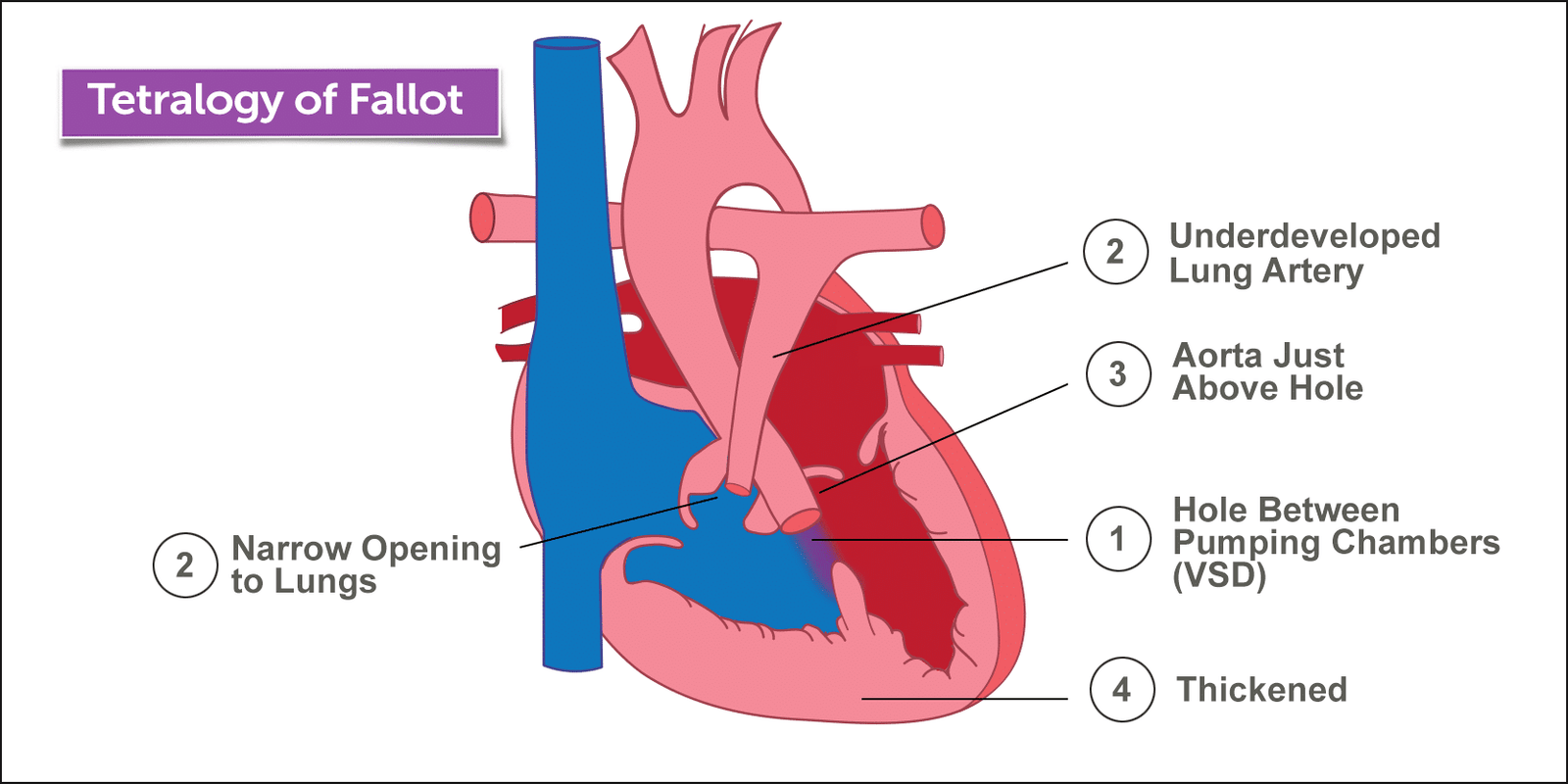 رباعية فالو