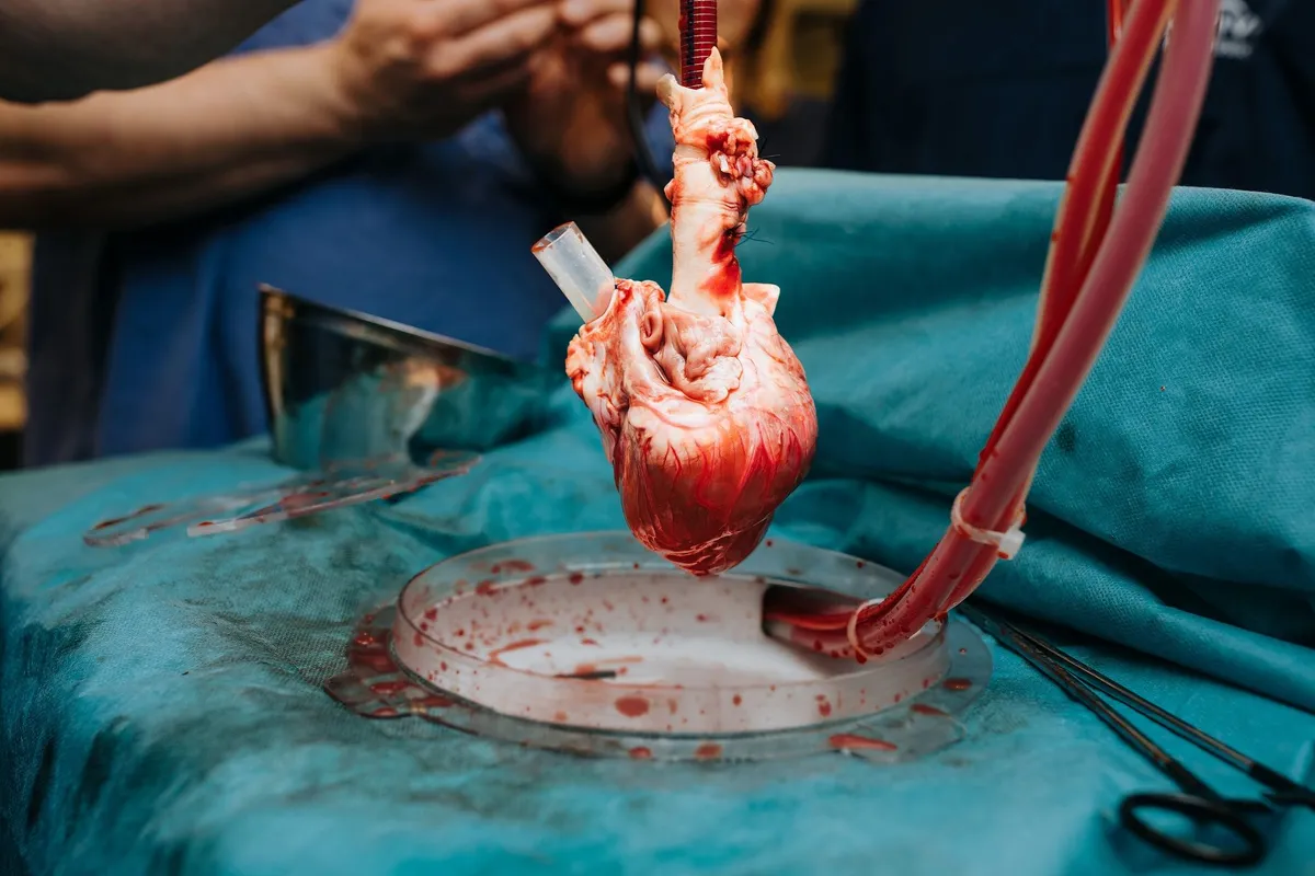 زراعة القلب للاطفال
