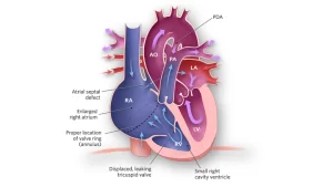 شذوذ إيبشتاين