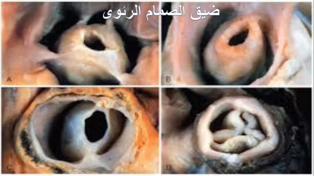 ضيق الصمام الرئوي عند الأطفال 3 ضيق الصمام الرئوي عند الأطفال