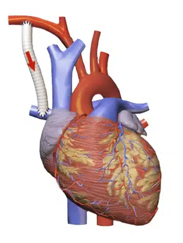 رباعية فالوت عند الرضع tetralogy of Fallot 4 عملية الشنت او الوصلة الشريانية