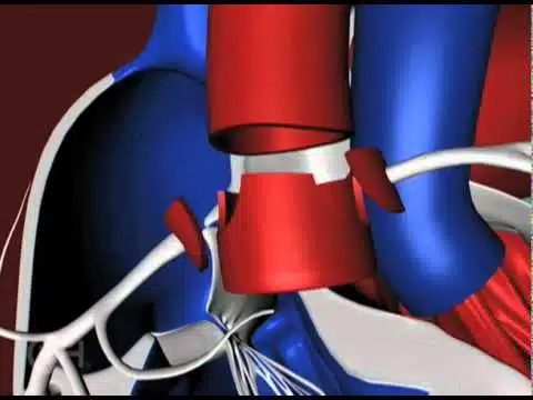 عملية تبديل الشرايين الكبرى