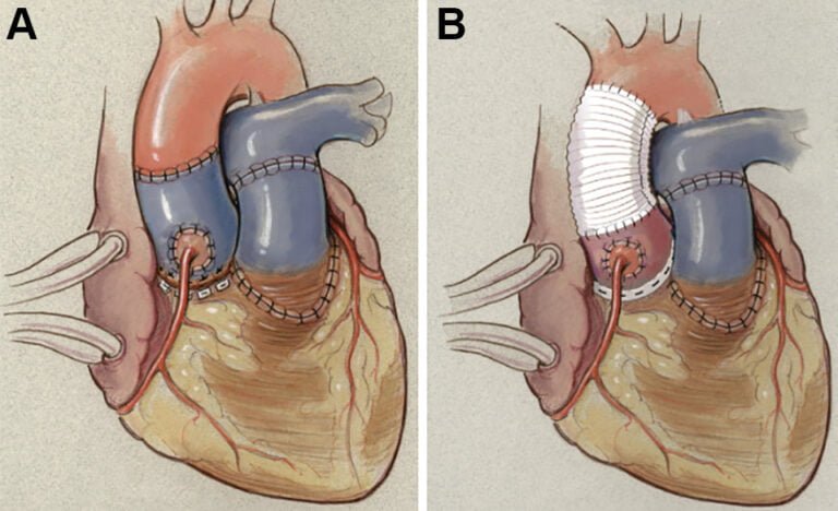 عملية روس للقلب