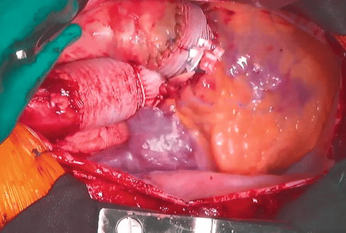 عملية روس للقلب : ROSS OPERATION 5 عملية روس للقلب
