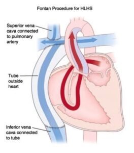 عملية فونتان - إجراء فونتان