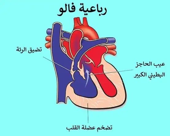 ما هو رباعي فالوت 2 ما هو رباعي فالوت