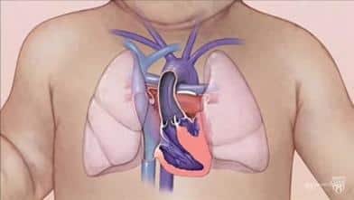 متلازمة القلب الأيسر ناقص التنسج 3 متلازمة القلب الأيسر ناقص التنسج