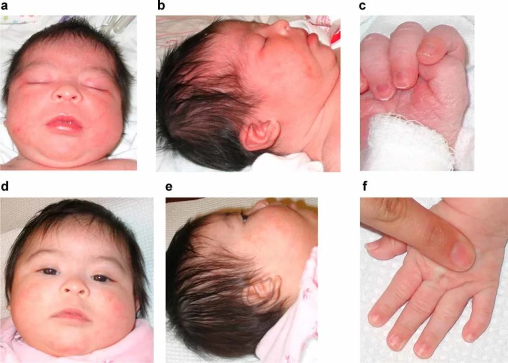 متلازمة داون والقلب في الاطفال 3 متلازمة داون والقلب في الاطفال