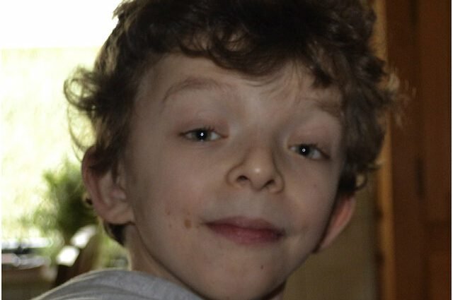 متلازمة نونان وامراض القلب الخلقية 6 متلازمة نونان