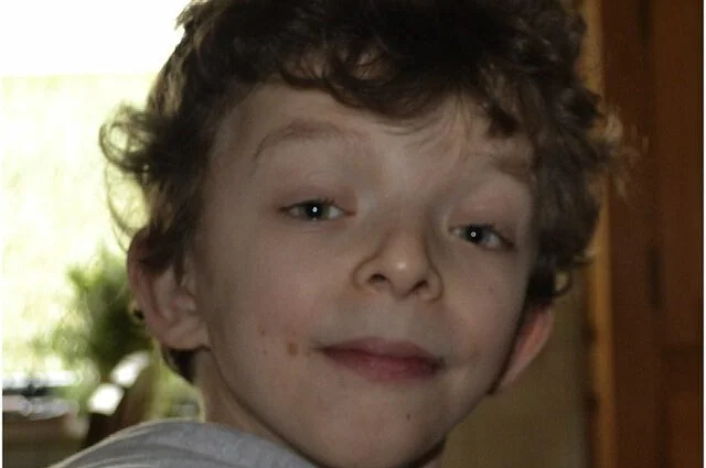 متلازمة نونان وامراض القلب الخلقية 6 متلازمة نونان