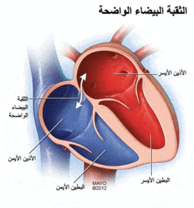 الثقب الجنيني في القلب