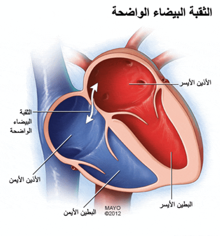 الثقب الجنيني في القلب 9 الثقب الجنيني في القلب