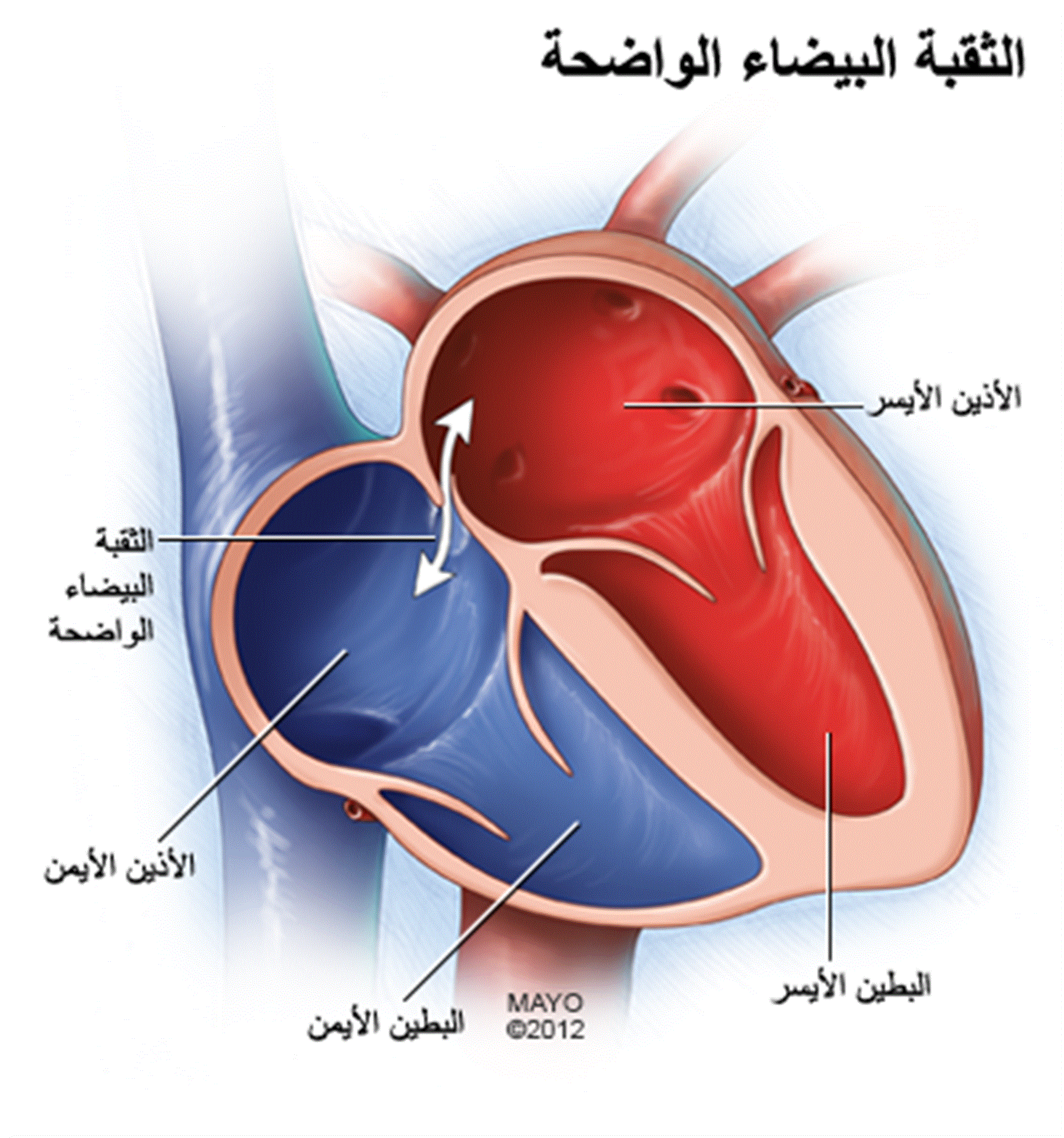 الثقب الجنيني في القلب